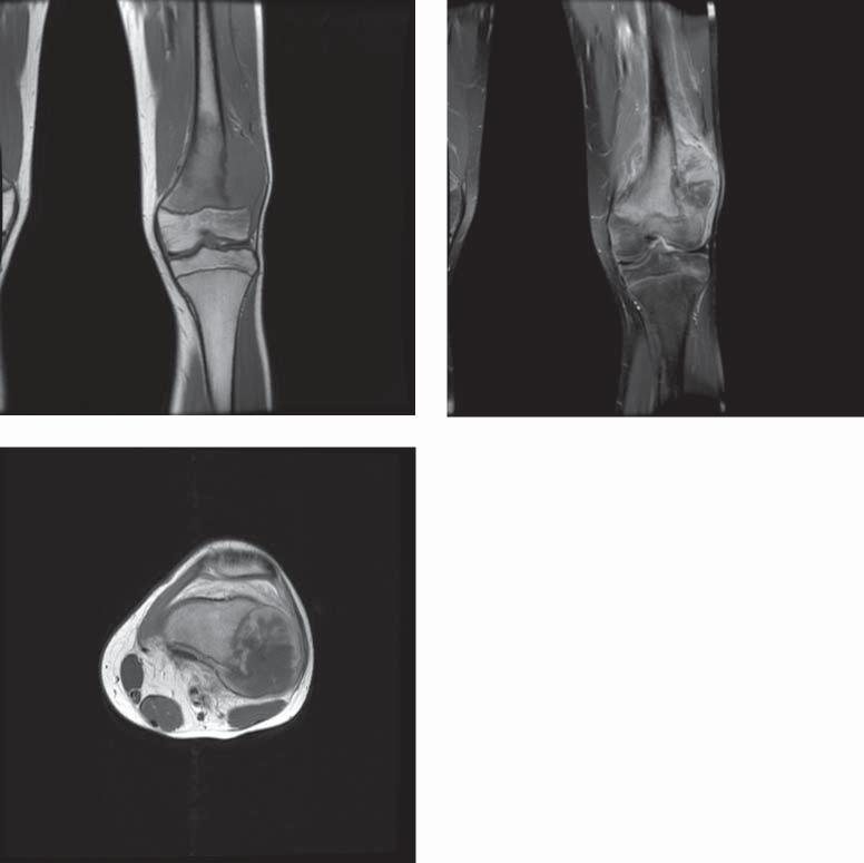 24 A microscopic image of osteosarcoma. There are visible cells of mesenchymal origin with traits of atypy, producing an extracellular substance, i.e. in this case - osteoid (which is the basic distinguishing feature of that tumour) [Fig.