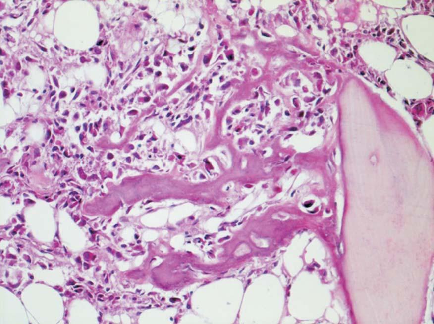 Suitability of imaging methods (X-ray, CT, MRI) in the diagnostics of osteosarcoma in children.