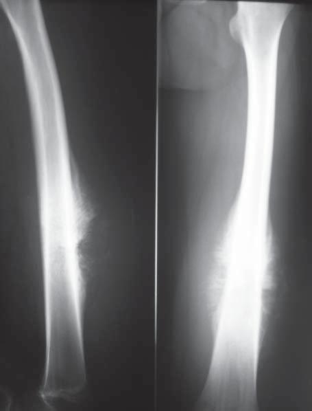18 At the moment of diagnosis, in 13 children (35.