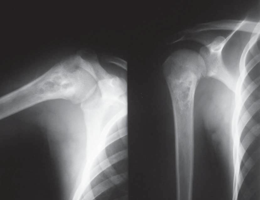 20 All the 18 children who were administered the contrast medium displayed an intensification of the tumour mass, which allowed a better assessment of the tumour morphology and the extent of its