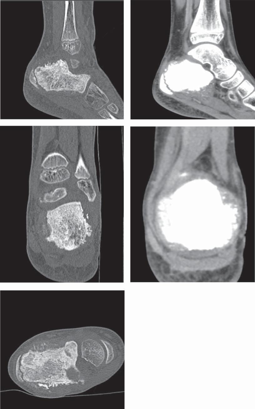 Suitability of imaging methods (X-ray, CT, MRI) in the diagnostics of osteosarcoma in children... 21 growth of the tumour mass. Fig.5 illustrates the dynamics of the lesion growth.