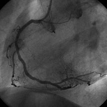 Ryc. 4. Implantacja stentu. Fig. 4. Deployment of the stent. Ryc. 5.