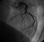 Occlusion of the mid-portion of the left anterior descending artery TIMI flow