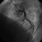 Obraz angiograficzny po przejściu prowadnikiem przepływ TIMI 0. Fig. 7.