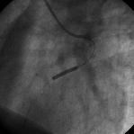 8. Implantacja stentu. Fig. 8. Stent implantation. Ryc. 9.