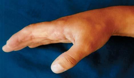 34 T. MAZUREK, A. LORCZYŃSKI, A. ŁABUĆ ments of active flexion of the finger with restriction of passive and active extension limited by the orthesis.