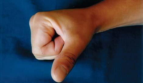 DIP of 10 degrees (actively and passively). Also, it was found that there was pulling of skin to the tendon graft in the area of palmar flexion line. Surgical tenolysis of the tendon was performed.