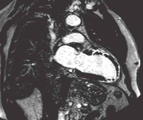 Folia Cardiologica Excerpta 2011, tom 6, nr 1 w postaci obszarów znajdujących się wzdłuż granicy zawału o pośredniej intensywności sygnału. Schmidt i wsp.
