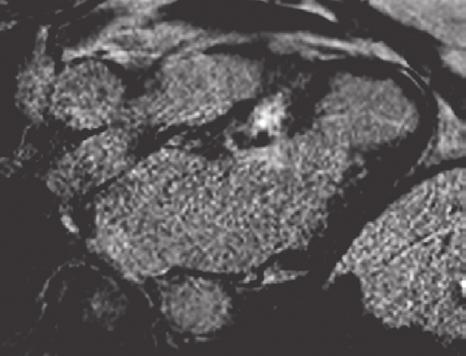 Folia Cardiologica Excerpta 2011, tom 6, nr 1 A B Rycina 3.