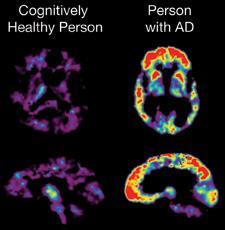 PET scans show 11C-PIB uptake 11C- PiB