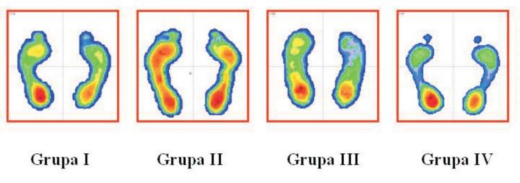 32 J. LORKOWSKI, W. HŁADKI, M. TRYBUS, D. ZARZYCKI time, in the mechanism of the positive retroaction the degenerative changes themselves cause the biomechanical changes [13,23,24].