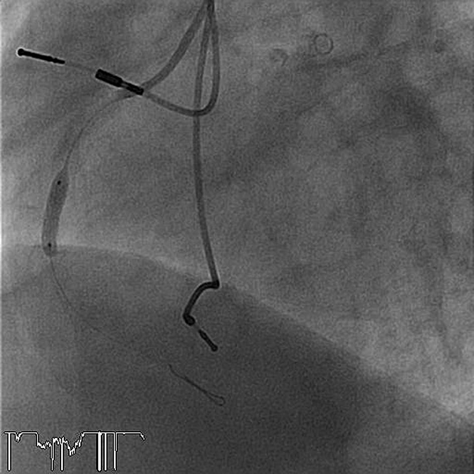 1004 Marek Koziński et al. Rycina 5. Implantacja stentu Multi-Link Vision 3,5 15 mm ciśnieniem 24 atm w miejscu dyssekcji Rycina 6.