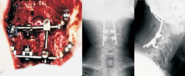 42 M. TĘSIOROWSKI, D. ZARZYCKI, E. LIPIK, L. CIUPIK Because of that the anchors were installed more lateral, to avoid of the risk of breaking locating them too close to bone edge.