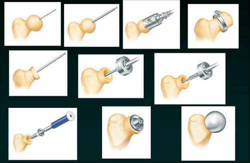 BMHR - Birmingham Mid Head Resection Jest to wariant pośredni endoprotezy stawu biodrowego między endoprotezą powierzchniową (kapoplastyką) a endoprotezą totalną.