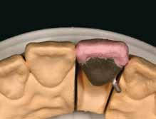 4 Aplikacja Dentyny i Porcelany szkliwnej 1 Aplikacja Dentyny (Body) Pierwsze nałożenie
