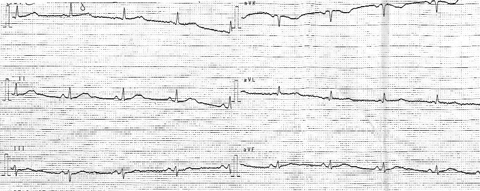 1334 Agnieszka Zienciuk et al. Rycina 1. EKG w trakcie hospitalizacji (4 kwietnia 2007 r.).