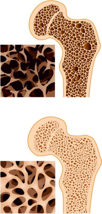 GENETYCZNE PREDYSPOZYCJE DO OSTEOPOROZY I USZKODZEŃ CHRZĄSTKI STAWOWEJ Osteoporoza jest chorobą o wieloczynnikowej etiologii; diagnozowana jest poprzez pomiar gęstości mineralnej kości (pomiar BMD).