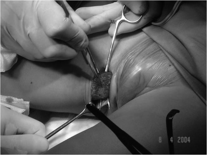 Borowski A et al., Adductor Myotomy Versus Adductor Transfer to Ischiadic Tuber in the Therapy of Spastic Hip Ryc. 1.
