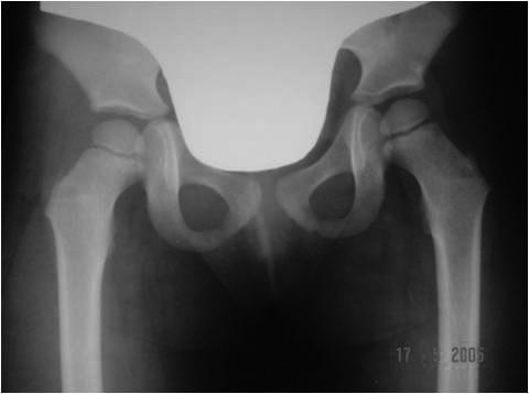 Borowski A et al., Adductor Myotomy Versus Adductor Transfer to Ischiadic Tuber in the Therapy of Spastic Hip Ryc. 3a,b.