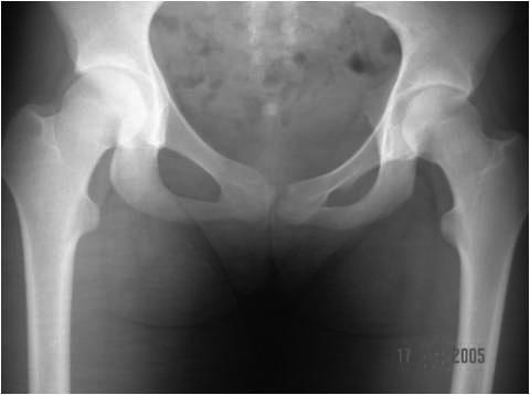 Hip radiograph before thigh adductor transfer and at the latest follow-up examination (10 years post-op) w grupie miotomii mięśni przywodzicieli uda wynosił średnio 33% (Rycina 2) oraz 38% w grupie