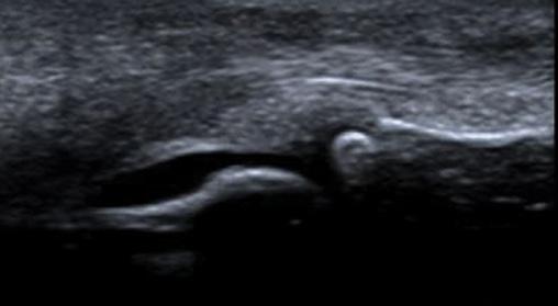 Diagnostyka obrazowa młodzieńczych spondyloartropatii. Część II: Ultrasonografia i rezonans magnetyczny Ryc. 1. Wysięk, pogrubienie i wzmożone unaczynienie błony maziowej:.