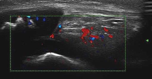 Diagnostyka obrazowa młodzieńczych spondyloartropatii. Część II: Ultrasonografia i rezonans magnetyczny Ryc. 5. Obrzęk, cechy wzmożonego unaczynienia tkanki tłuszczowej śródstawowej:.