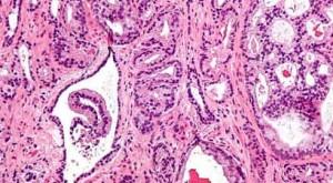 Leki na prostatę zwiększają ryzyko raka prostaty Inhibitory 5-alfa reduktazy, finasteryd i dutasteryd, które wskazane są do stosowania w łagodnych postaciach rozrostu prostaty, równocześnie