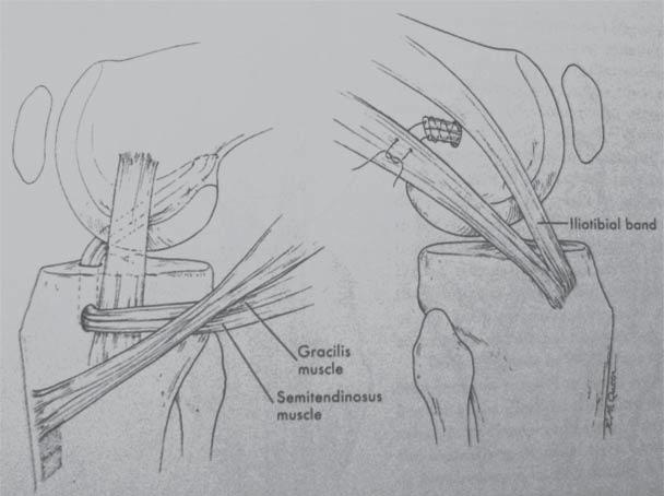 30 M. JABŁOŃSKI, J. JARECKI, M. GORZELAK cruciate ligament impairment were incorporated into the group under examination.