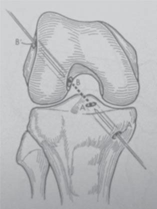 After the procedure the limb was initially immobilized by means of cast or knee joint stabilizer.