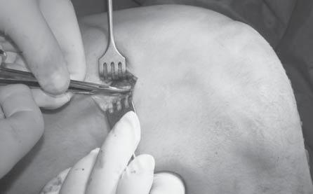 With a femoral pointer the femoral bone canal was drilled. The starting point was situated between the anterior-medial fasciculus and the posterior-lateral ACL.