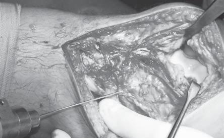 tendons. The tendons were further stabilized in the femoral region at the screw [5]. RESULTS Over the period 2004-2007 10 patients have been operated on (9 men and 1 woman).