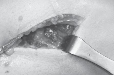 Anterior cruciate ligament reconstruction using Puddu method preliminary report 33 ultrasonography in 3 patients.