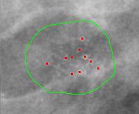 Detekcja potencjalnych klastrów mikrozwapnień Wejście: mammogram Klaster mikrozwapnień Lokalizacja: centra jasnych plam