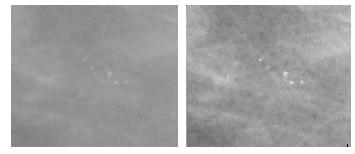 Metody uwydatnienia mikrozwapnień (MammoViewer) Filtracja w przestrzeni obrazu Korekcja histogramu Eliminacja tła poprzez odejmowanie obrazu wygładzonego