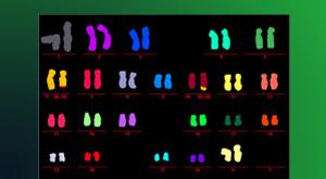 Niedobory nukleotydów przyczyną niestabilności chromosomalnej Niestabilność chromosomalna (ang. chromosomal instability, CIN) jest cechą charakterystyczną komórki nowotworowej.
