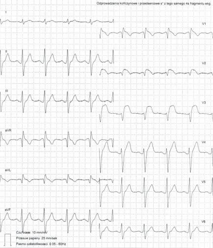 Beata Uziębło-Życzkowska i wsp., Utajona postać zespołu Brugadów Rycina 2. Zapis 12-odprowadzeniowego EKG u 52-letniego pacjenta po podaniu ajmaliny dożylnie (fragment zapisu EKG metodą Holtera).