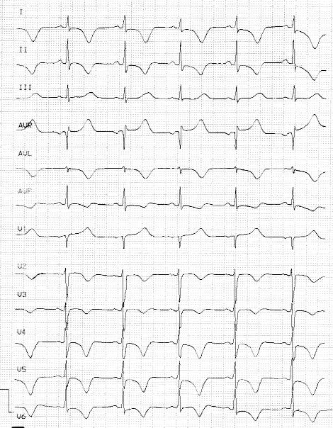 Ostry zawa³ serca w okresie oko³oporodowym 555 Rycina 1. Zapis EKG przy przyjêciu na OIOK. Rytm zatokowy miarowy 62/min, ujemne za- ³amki T w odprowadzeniach I, II, avl, V2-V6. Rycina 2.