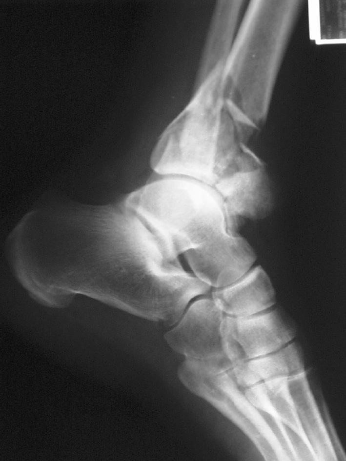 Złamaniom kości pisz - czelowej towarzyszy najczęściej złamanie strzałki na różnych poziomach oraz uszkodzenie więzozrostu piszczelowo-strzałkowego.