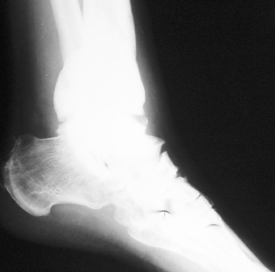 Post-traumatic degenerative changes of the crurotalar joint. No dorsoflexion of the foot pierścień na k. piętowej lub ramkę na stopę, połą czo - ne zawiasami z głównym aparatem (Ryc. 3 a,b).