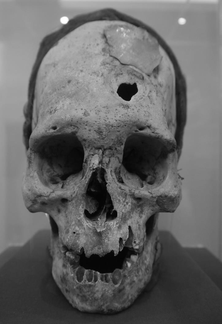 ryc. 1. Czaszka kultury Paracas otwór trepanacyjny zasłonięty złotą blaszką (fot. J.