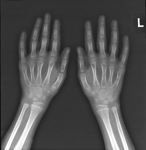 Diagnostyka obrazowa młodzieńczych spondyloartropatii. Część I: Klasyfikacje i radiogramy A Ryc. 5.