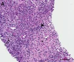 Biopsja wątroby w DILI Wzrost testów wątrobowych/postępujące upośledzenie wydolności wątroby mimo wycofania