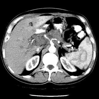 Pancreatic Cancer by Stage (SEER