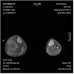 A large tumour can be seen extending from the head to the distal third of the fibula, with distinct malignant periosteal reactions and soft tissue shadow Wykonano resekcję guza wraz z całą kością