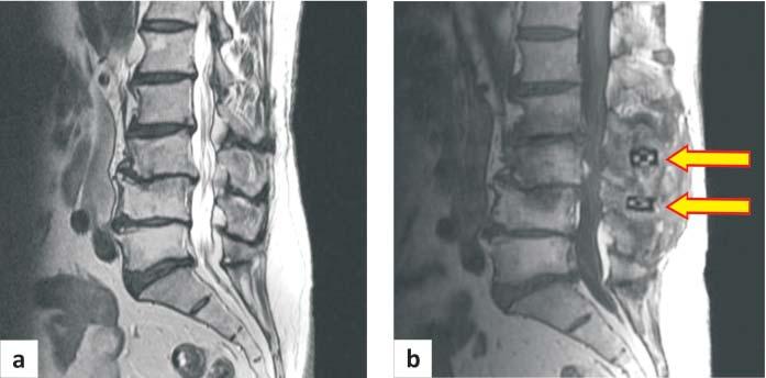 In this case interspinous stabilization was only one of compounds, which caused improvement of patients state. 3. In one case, joint s iatrogenic disease was claimed (fig. 8, 9).