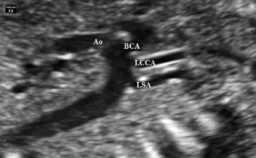 second trimester scan. Material and methods: Since January 2012 our center has started to conduct the assessment of the position of the right subclavian artery in the second trimester scan.