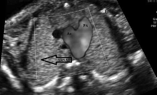 podwyższonym ryzykiem wad genetycznych i anatomicznych, zakwalifikowanych do programu badań prenatalnych