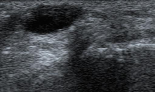 łędy i pomyłki w diagnostyce ultrasonograficznej układu mięśniowo-szkieletowego przyczyny i sposoby ich unikania Ryc. 3. Obraz okolicy grzbietowej nadgarstka, przekrój poprzeczny:.
