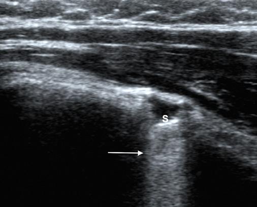 łędy i pomyłki w diagnostyce ultrasonograficznej układu mięśniowo-szkieletowego przyczyny i sposoby ich unikania Z jednej strony cień za zwapnieniem jest korzystny, z drugiej strony, jeżeli jest
