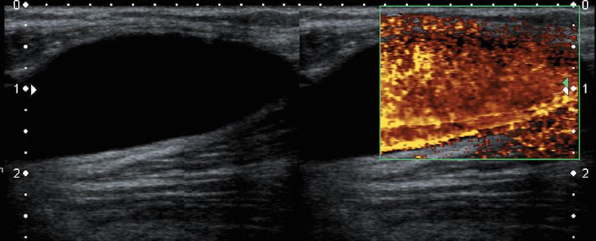 łędy i pomyłki w diagnostyce ultrasonograficznej układu mięśniowo-szkieletowego przyczyny i sposoby ich unikania Ryc. 13.